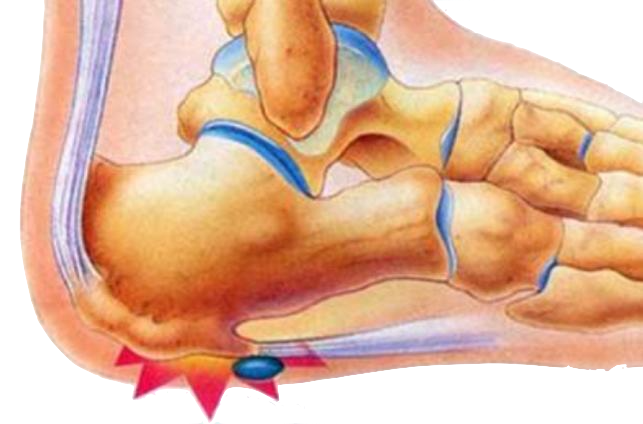 Bone spurs hot sale plantar fasciitis